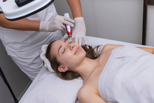 Scarlet RF Microneedling in Las Vegas 2